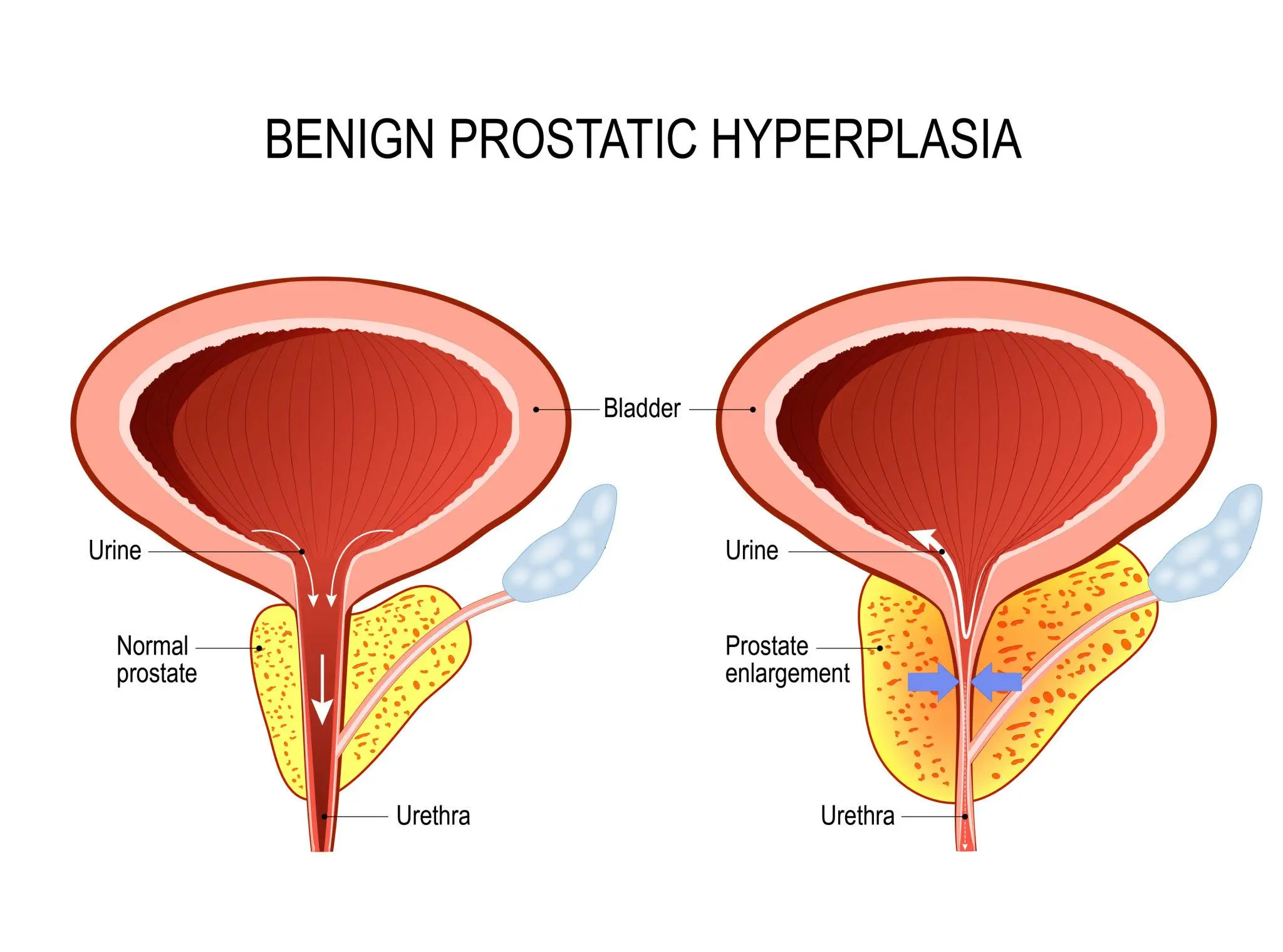 Medical diagram showing Benign Prostatic Hyperplasia (BPH) comparison between a normal and an enlarged prostate.
